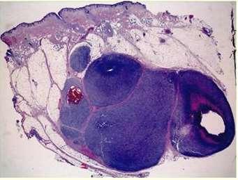Microsatelitosis/satelitosis: Presencia de nidos tumorales >0,05mm