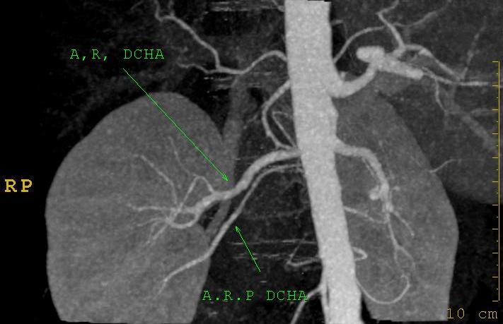 Imagen MIP ( A ) y con reconstrucción Volume Rendering ( B ) que muestran variantes del origen de la arteria del segmento inferior: la arteria nace en