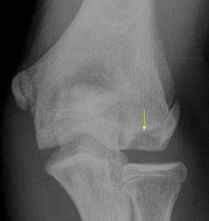 Enfermedad de Panner Osteonecrosis de condilo humeral externo (capitellum) Microtraumatismos por lanzar.(beisbol, gimnasia) 5-10 años.