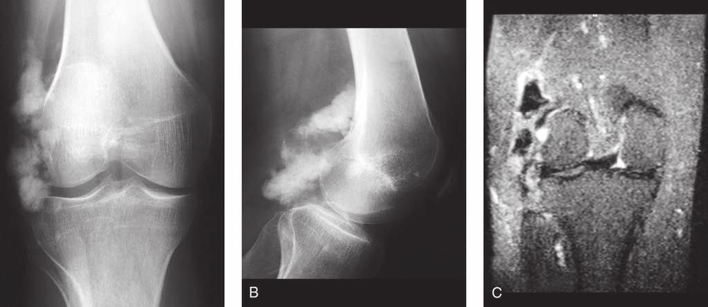 Sección Figura 1 Figura 2 Melorreostosis. A, Radiografía anteroposterior que muestra formación perióstica de hueso en la zona lateral de la rodilla.
