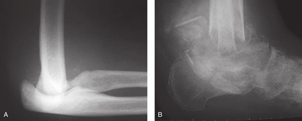 Sección Figura 5 Artropatía neuropática. A, Radiografía lateral del codo de un paciente con siringomielia.