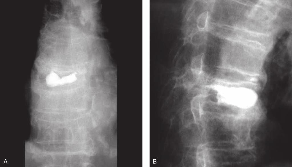 Sección Figura 5 Radiografías anteroposterior (A) y lateral (B) de la columna vertebral de una mujer con cáncer de pulmón con metástasis en una vértebra dorsal, que provocó su aplastamiento con