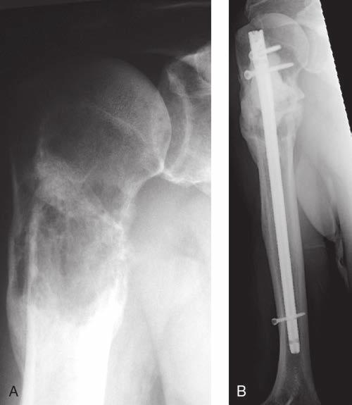 Capítulo 51: Patología ósea metastática Figura 6 Radiografías de la extremidad superior de un varón de 67 años diestro con una metástasis de carcinoma renal que presentaba dolor en reposo y al mover