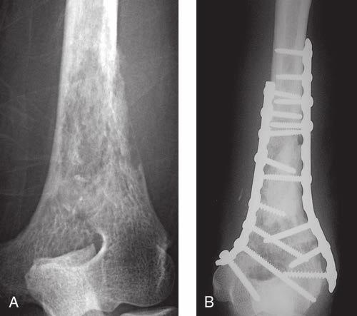 La paciente tenía dolor persistente a pesar de la radioterapia de la metástasis. B, Radiografía anteroposterior postoperatoria tras legrado, cementado y fijación de la lesión con placa doble. 6.