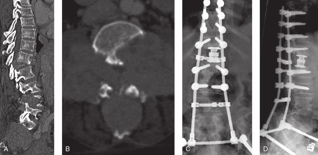 Capítulo 51: Patología ósea metastática Figura 16 Imágenes de la columna vertebral de una mujer de 57 años con cáncer de tiroides metastatizante.
