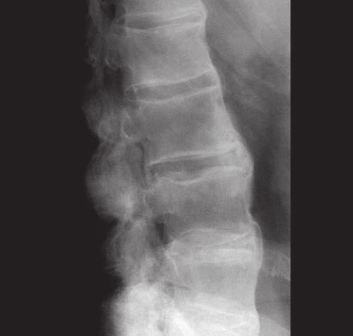 Sección Figura 5 Radiografía lateral de la columna de un paciente con espondilitis anquilosante. Obsérvese cómo los osteofitos anteriores unen todas las vértebras lumbares. E. Anatomía patológica 1.