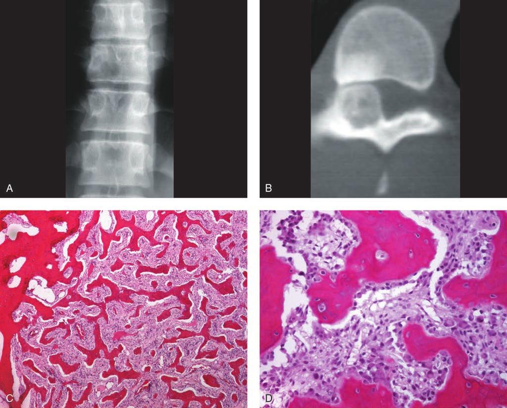 Capítulo 46: Tumores óseos benignos y lesiones reactivas Figura 2 Osteoblastoma.