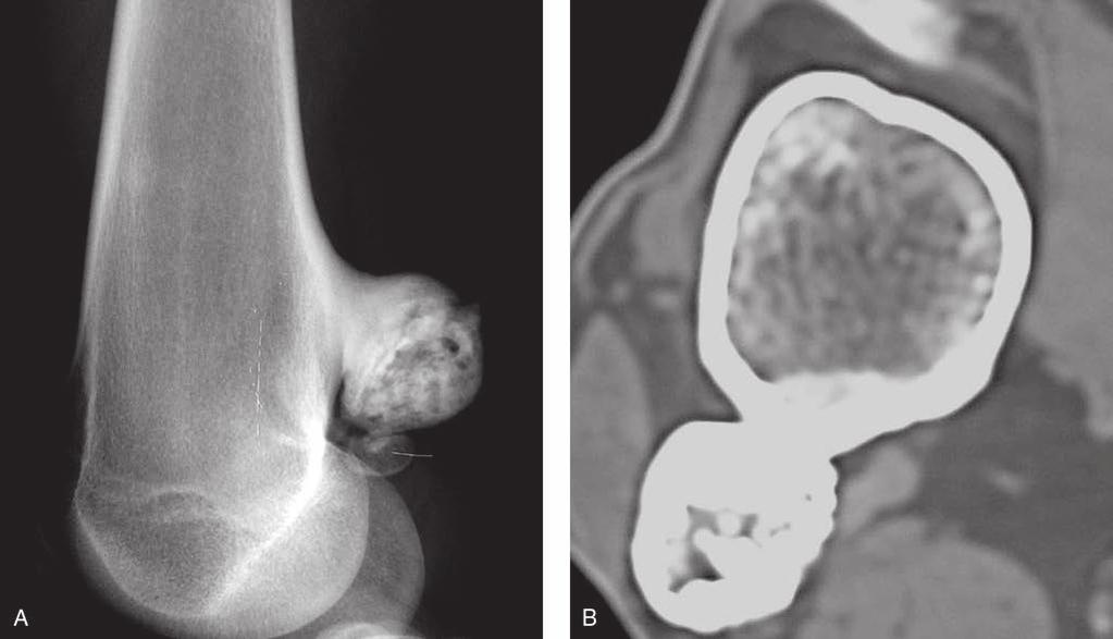 Capítulo 46: Tumores óseos benignos y lesiones reactivas Figura 3 Osteoma paraostal.