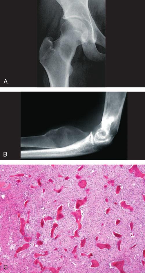 Sección Figura 11 Displasia fibrosa. A, Radiografía anteroposterior del fémur proximal derecho de una joven de 18 años con dolor inguinal.