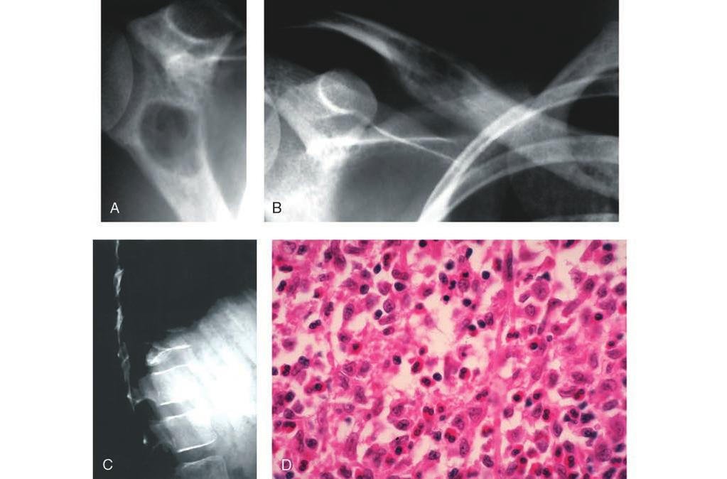 Capítulo 46: Tumores óseos benignos y lesiones reactivas Figura 14 Granuloma eosinófilo/histiocitosis de células de Langerhans.