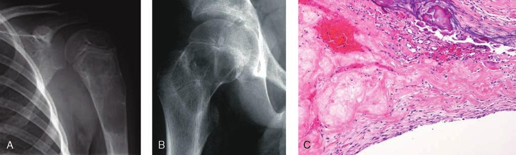 Capítulo 46: Tumores óseos benignos y lesiones reactivas Figura 15 Quiste óseo unicameral.