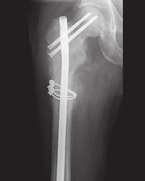 Sección Figura 4 La radiografía muestra el fémur proximal de un hombre de 43 con sospecha de metástasis. Se colocó un clavo intramedular en el fémur derecho.