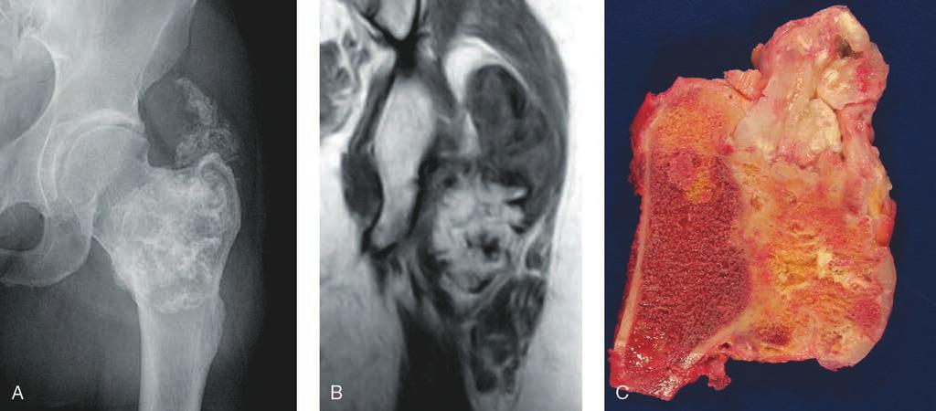 B, La RM frontal en T1 revela que el osteocondroma tiene el mismo aspecto que la médula ósea pélvica adyacente, pero la zona proximal está formada por partes blandas, compatible con degeneración