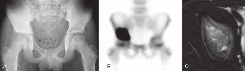 Sección Figura 19 Sarcoma de Ewing de la pelvis. A, La radiografía anteroposterior de la pelvis muestra una anomalía indefinida en la región supracetabular derecha.