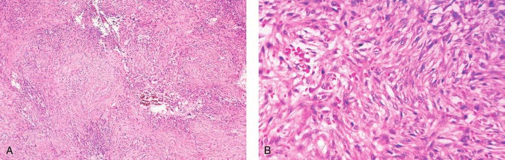 Sección Figura 8 Fascitis nodular. A, La imagen con microscopio de poco aumento revela una lesión muy celular con un patrón nodular (hematoxilina y eosina).