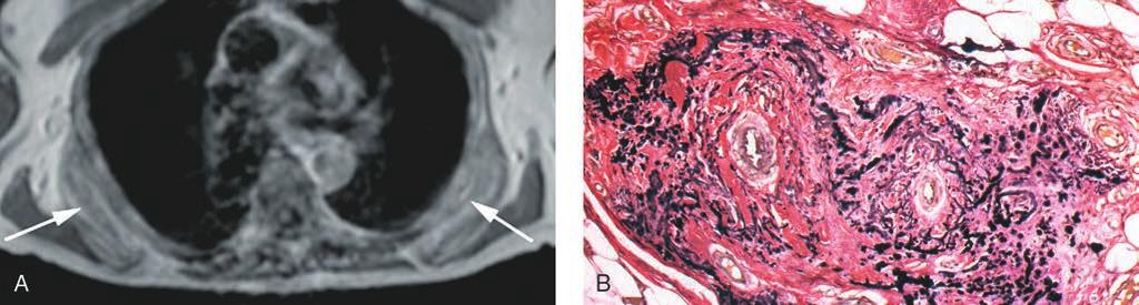 Capítulo 48: Tumores de partes blandas benignos y lesiones reactivas Figura 11 Elastofibroma.