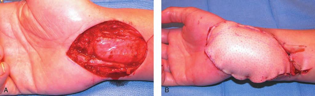 Sección Figura 1 Fotografías clínicas que muestran la muñeca de un paciente tras la resección de un sarcoma de tejidos blandos.