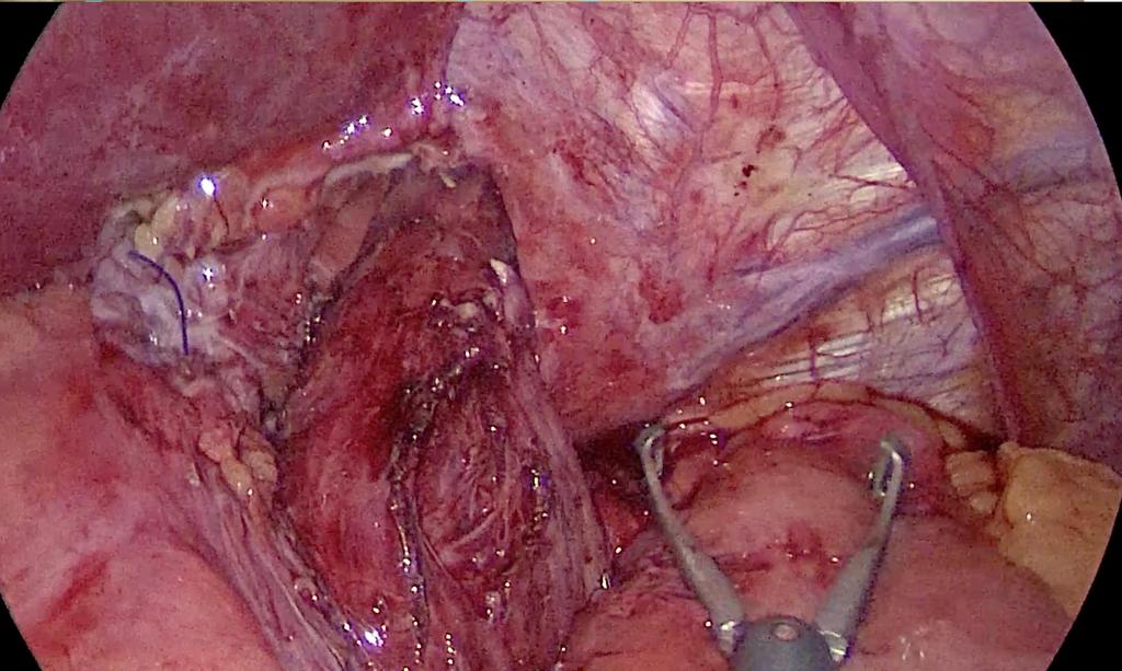 longitud esofágica intraabdominal