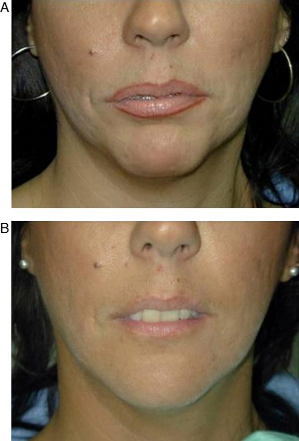 rev esp cir oral maxilofac.2013;35(2):59 68 63 tratamiento de arrugas, cicatrices y deformidades del contorno. - Hylaform (Genzyme Biosurgery, EE. UU.