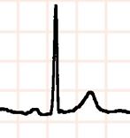 El ECG normal (importància de la memòria fotogràfica de ECG Normal) Nos fijamos tras valorar el ritmo cardiaco (sinusal o no) en un complejo representativo V5 I avr V1 Complejo QRS