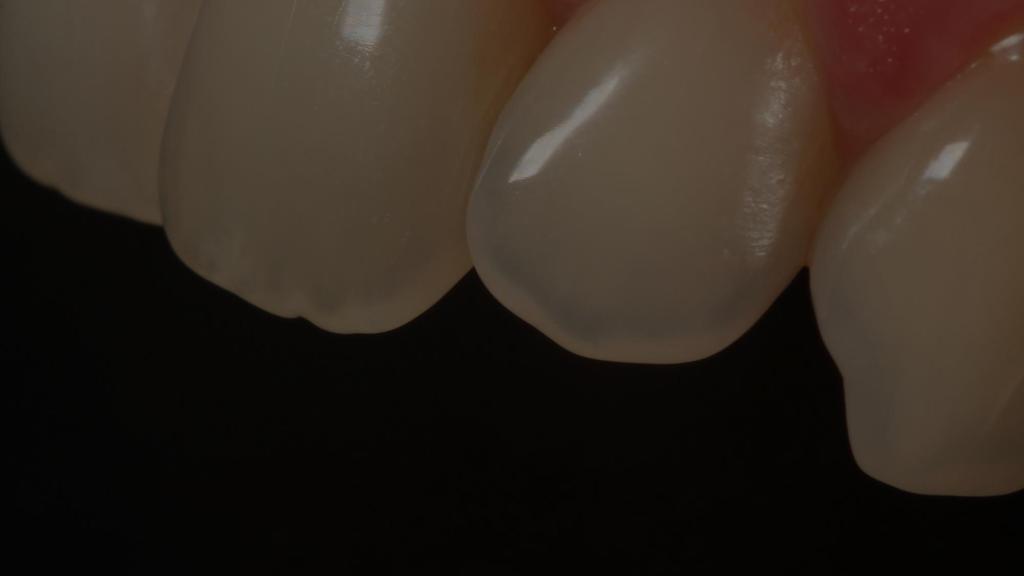 Alta Estética y Cosmética Dental Cómo lograr naturalidad con restauraciones directas