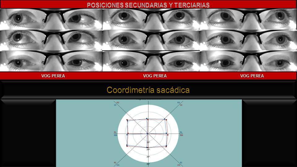 24 Figura 16-a. DVD bilateral asimétrica. DHD monolateral (ojo izquierdo).