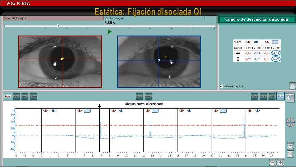 25 Figura 16-c. Mismo paciente. La oclusión del ojo izquierdo da lugar a un movimiento lento de elevación de este ojo (DVD) y otro más importante de abducción del mismo (DHD).