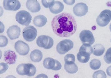 Morfología de sangre periférica Serie roja: sin alteraciones significativas. Serie plaquetar: presencia de macroplaquetas.