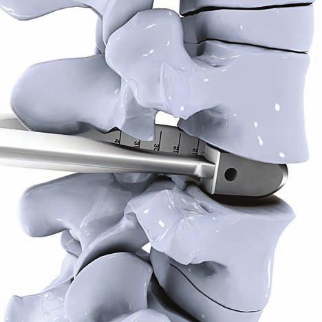 7 Colocación del implante de prueba Distractor/reamer de la altura deseada se mantiene en el espacio intersomático del lado