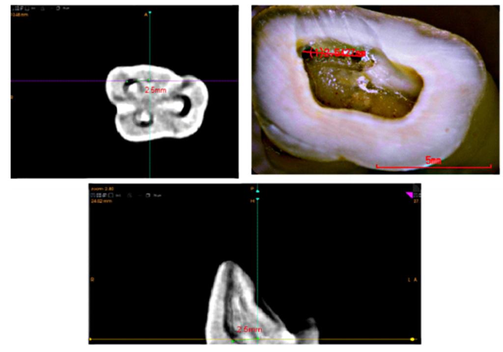 conductos, tomografías de primeros molares superiores que presentaran formación apical completa.