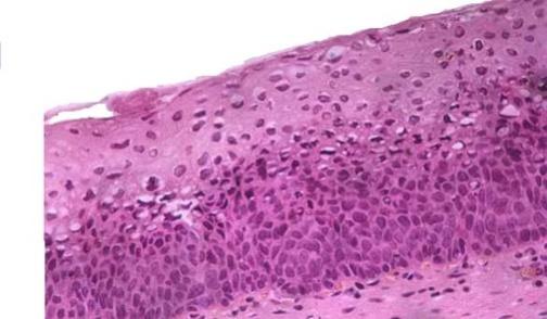 La lesión se limita al tercio basal del epitelio cervical. CIN2 (Grado 2): es considerada una lesión escamosa intraepitelial de alto grado.