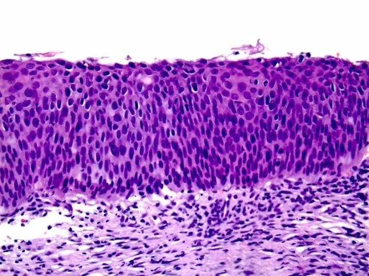 Ocupa más de 2/3 del epitelio cervical, en algunos casos incluyendo todo el grosor del revestimiento cervical. Dicha lesión se considera como un carcinoma in situ. CIN1 CIN2 CIN3 Figura 17.