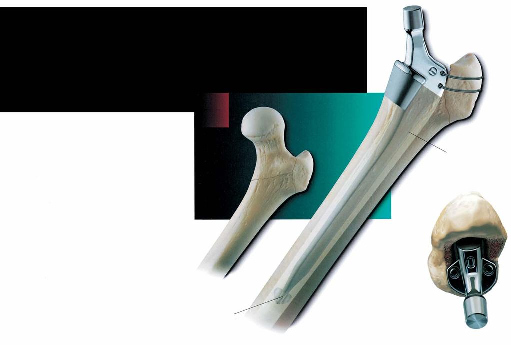 Cálcar F R A C T U R A S I N T E R T R O C A N T É R E A S Los vástagos más cortos (170mm y 180mm) de la próteisis VerSys CRC son ideales para artroplasitas totales de cadera primarias en ciertas
