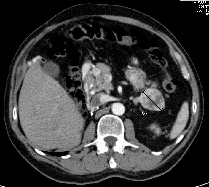 izquierda (40mm) - Nódulo en riñón izquierdo (21mm) Metástasis por CCR células claras