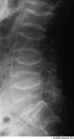 de columna > huesos largos Puede ser muy precoz (< 1 a) Colapso vertebral, fracturas patológicas, vértebras