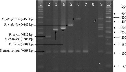 DIAGNÓSTICO MICROBIOLÓGICO PCR: SE OBSERVAN LAS