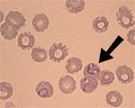 Babesiosis Enfermedad ocasionada por el protozoario Babesia