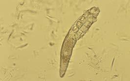 Figura 13: Neutrófilos y Macrófagos en Forunculosis Figura 14: Sobrecrecimiento Bacteriano en Cinta Adhesiva Figura 15: Macrófago con Amastigotes de Leishmania spp Fagocitados Figura