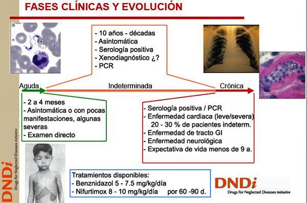 Enfermedad de Chagas: