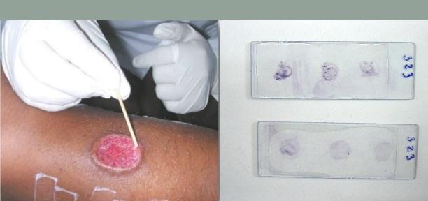 Examen directo: Toma de muestra: Incisión en el borde de la ulcera y toma de muestra por raspado.