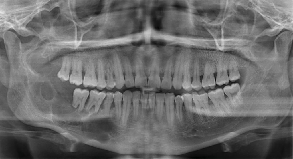 El uso del contraste para el diagnóstico de ameloblastoma: a propósito de un caso. Figura 1. Radiografía panorámica: imagen radiolúcida pseudolocular localizado en cuerpo y rama mandibular derecha.