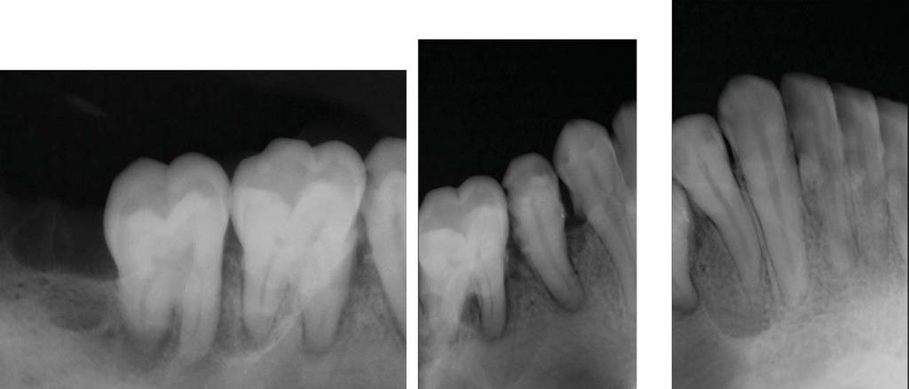 del conducto dentario inferior y la basal mandibular (figura1).