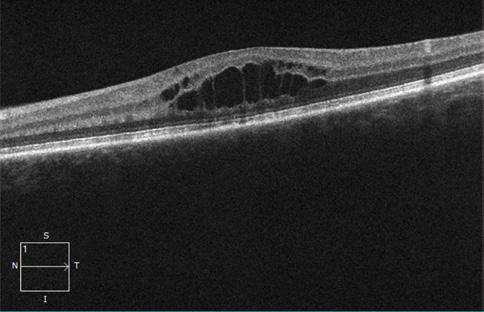 Biomicroscopía de polo anterior: No signos de inflamación activa ambos ojos. Fondo de ojo: OD Ausencia de células vítreas, no focos de retinitis/coroiditis. OI Papila hiperémica, células vítreas 0.