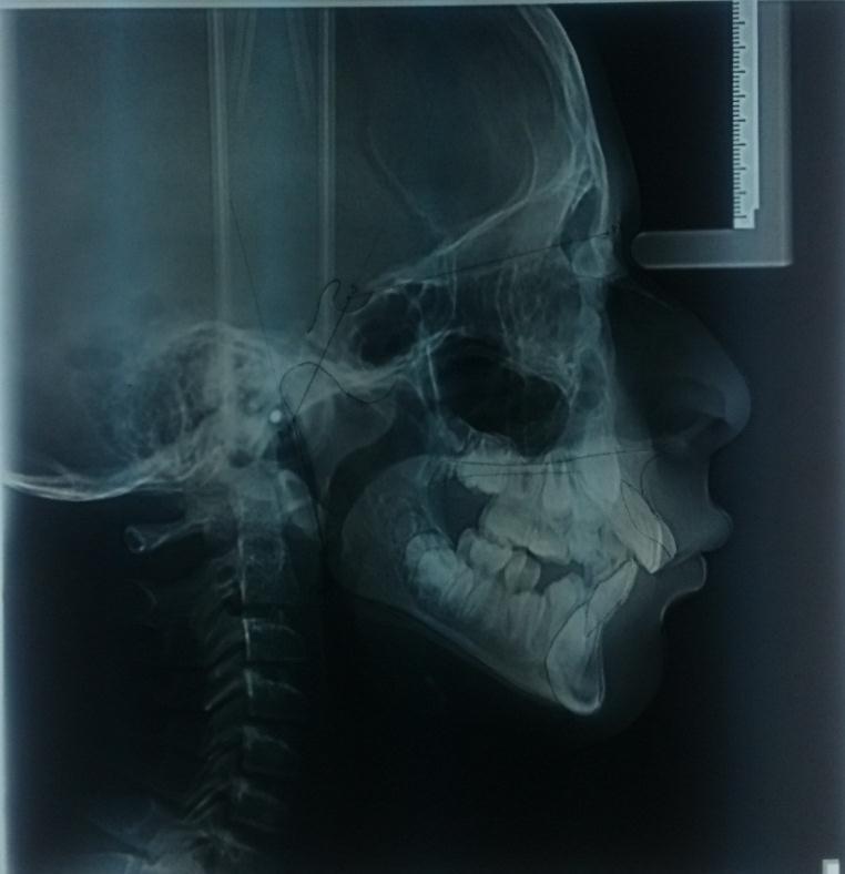 Grafico Nro. 55: Radiografia Cefálica Paciente Nro. 34 Tabla Nro. 42: Valores del análisis cefalométrico del Paciente Nro.