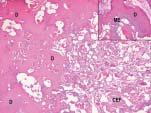 El examen histopatológico de este tejido fue informado como: Tumor Odontogénico Híbrido, compuesto por tumor odontogénico calcificante y odontoma complejo, además de focos de ameloblastoma folicular