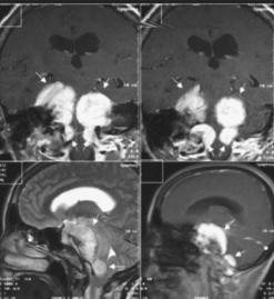 En B y C, imagen de RM T1 gadolinio en coronal de un paciente de la serie del autor (GLF) portadora de 4 meningiomas de la fosa posterior (2 del agujero magno, 1 petroclival y otro petroso anterior).
