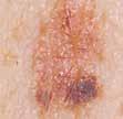 Un melanoma puede crecer en cualquier parte de su cuerpo, luego es importante chequear periódicamente toda la superficie de su cuerpo, (una vez al mes) para detectar posibles