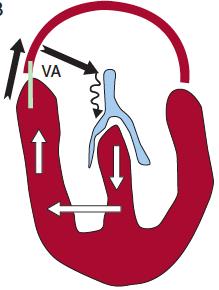 TAQUICARDIA AURICULOVENTRICULAR REENTRANTE VIAS ACCESORIAS Vías de conexión aurículo-ventriculares.