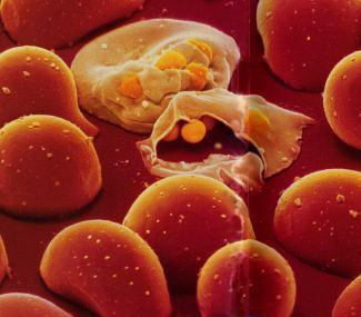 Patogenia de Malaria- Anemia 1.
