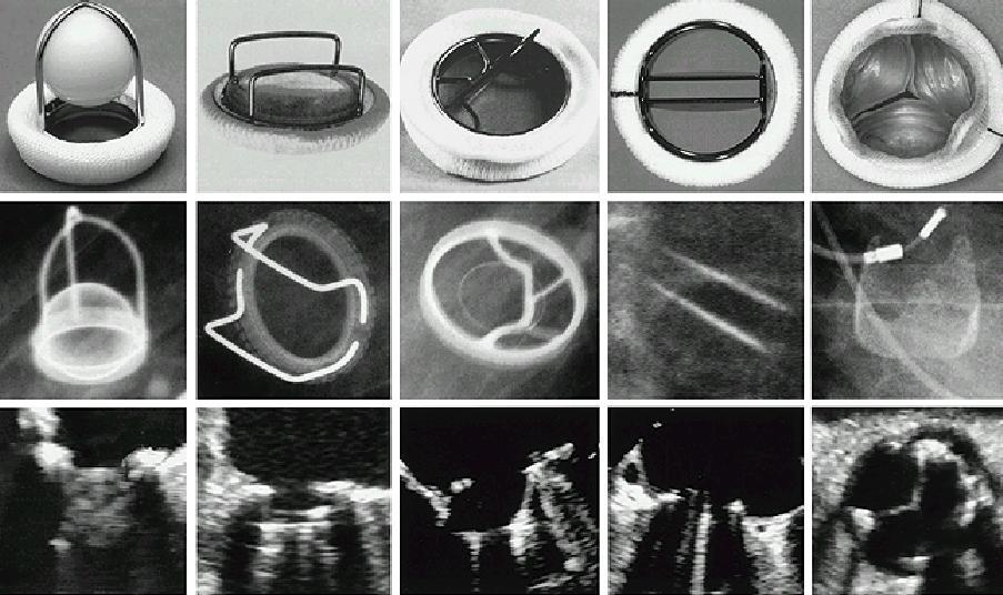 3 Fig. 1: Fotografía, radioscopía y Ecocardiografía de diferentes tipos valvulares.